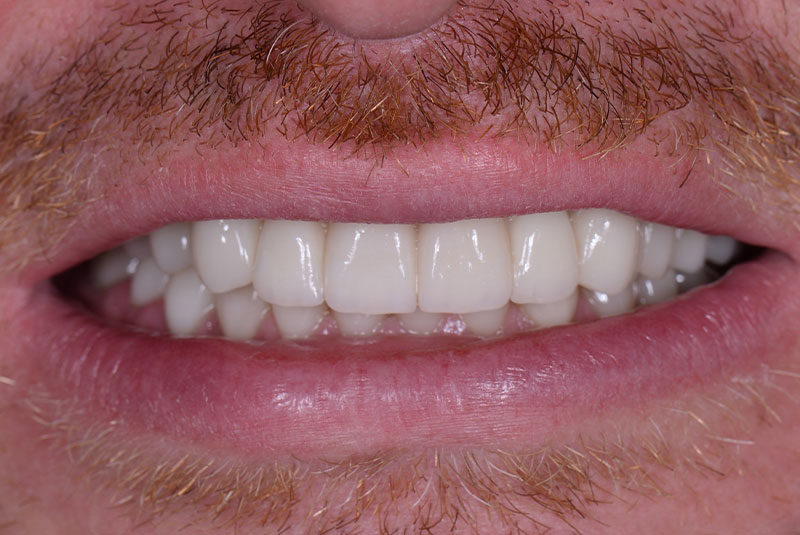 after dental implants