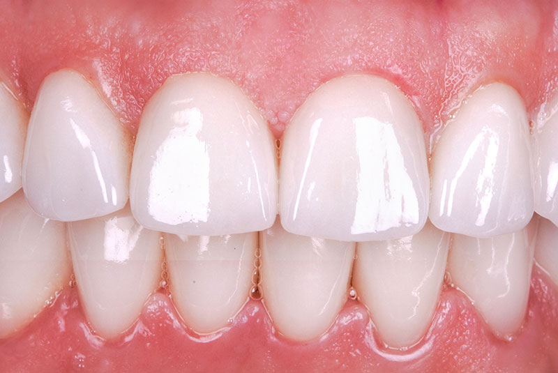 before dental implants