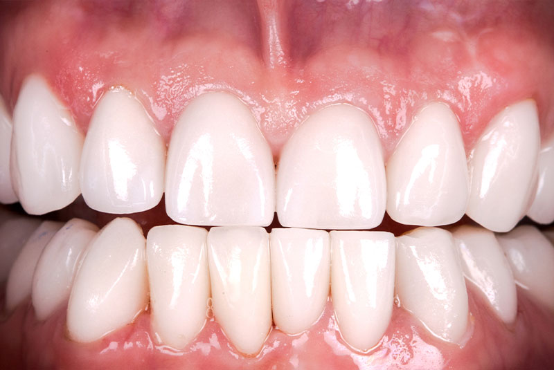 after dental implants