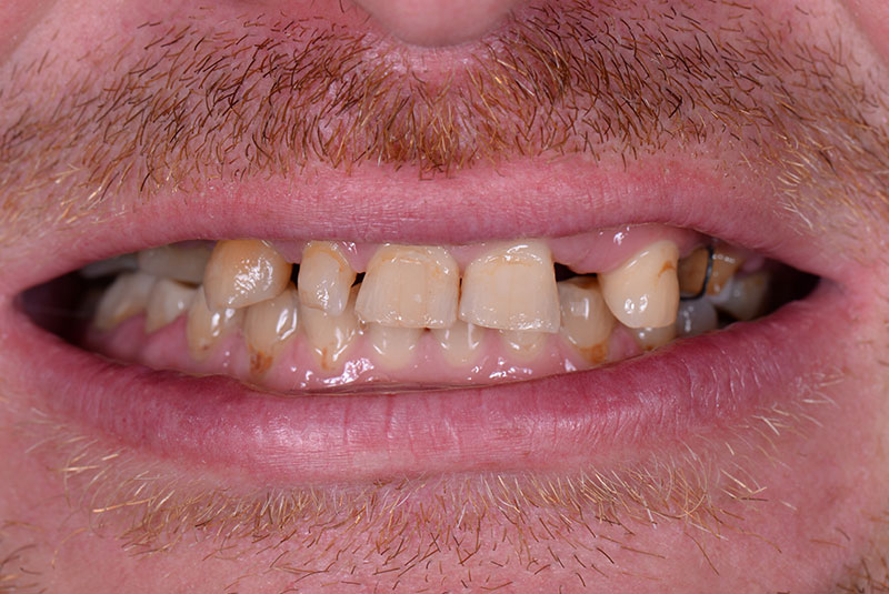 before dental implants