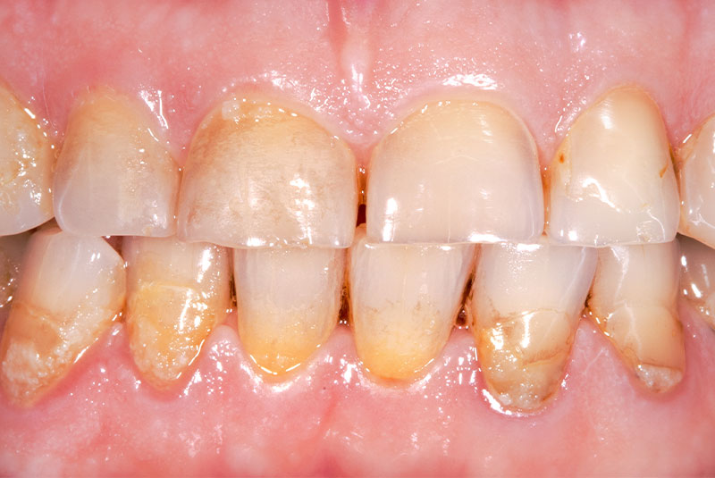 before dental implants