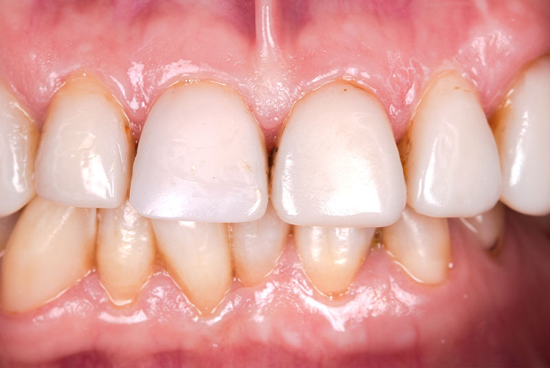 before dental implants