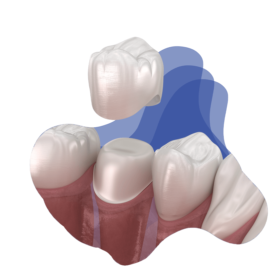dental crowns