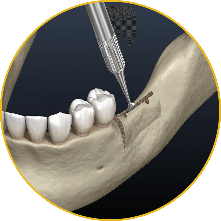 ridge splitting procedure