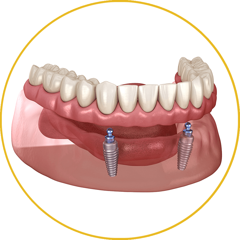 implant supported dentures